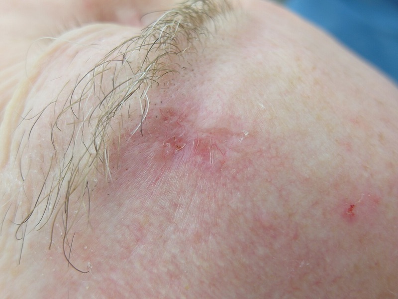 Micronodular basal cell carcinoma, clinical photograph