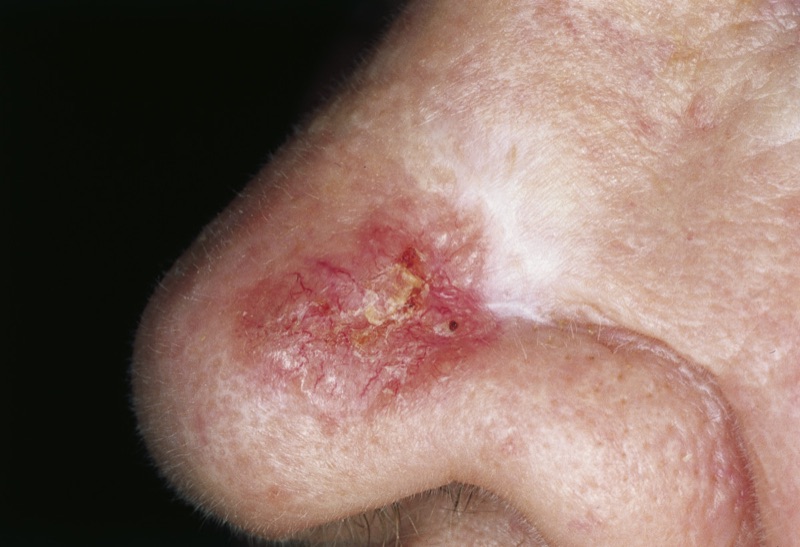 Morpheaform (scar-like) basal cell carcinoma on the nose