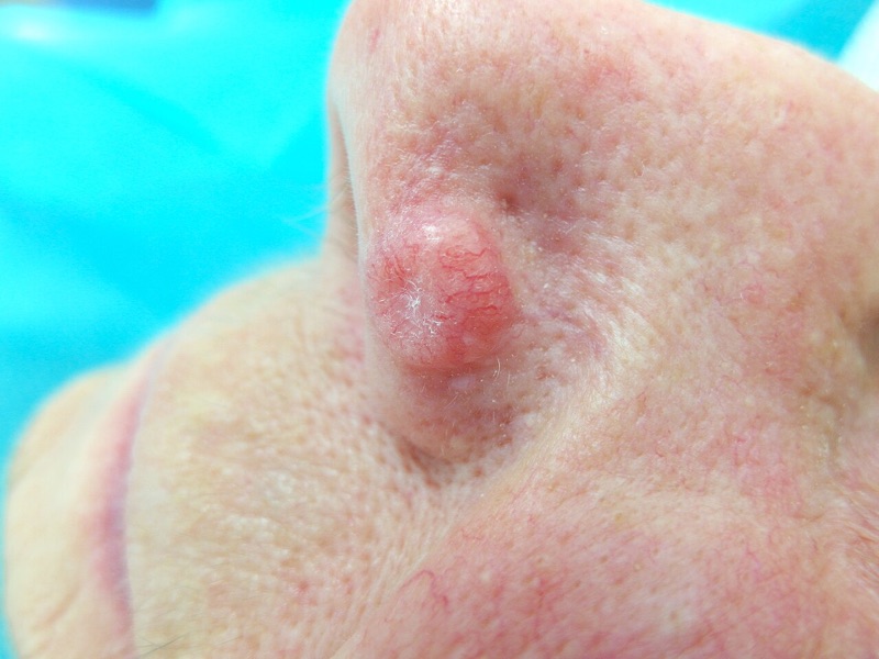 Nodular basal cell carcinoma on the nose, clinical photograph