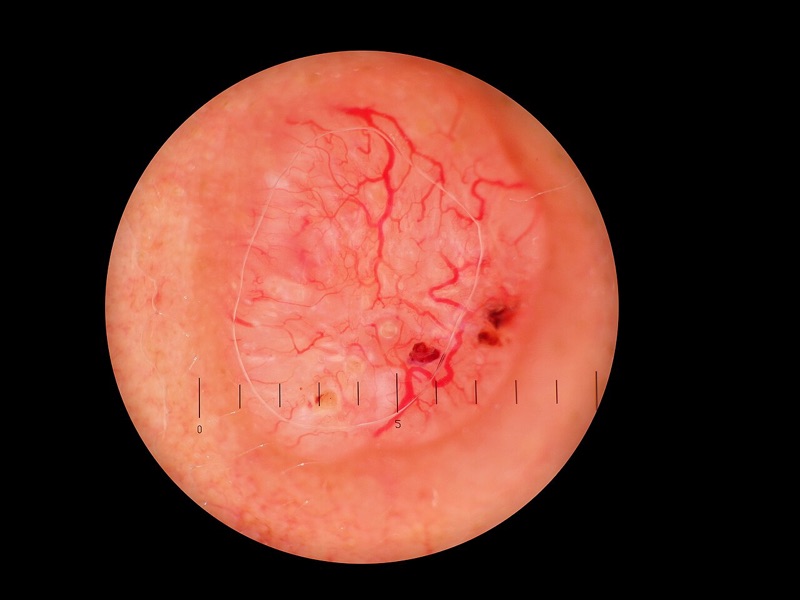 Dermoscopy image of a nodular basal cell carcinoma