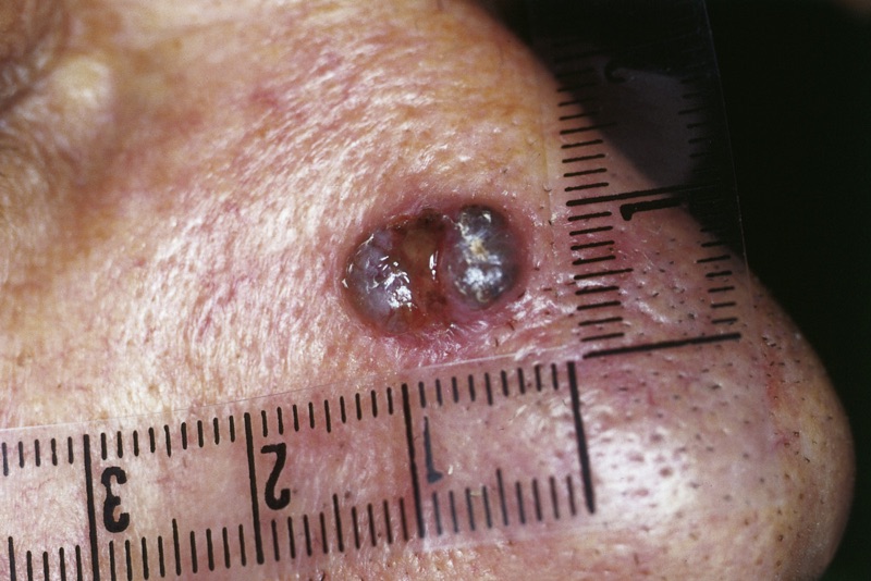 Pigmented basal cell carcinoma on the nose, measured with a ruler
