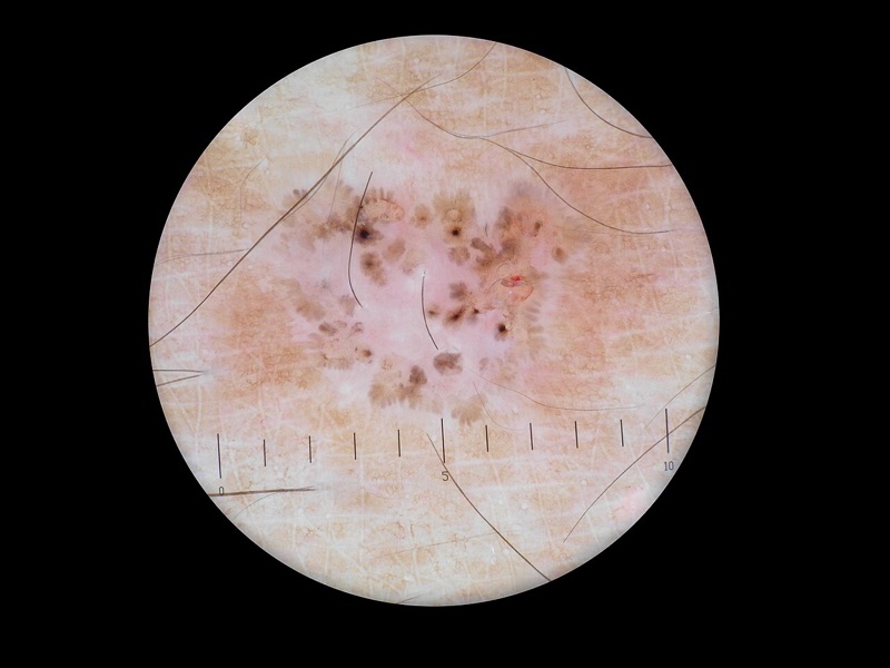 Dermoscopy image of a pigmented basal cell carcinoma on the back