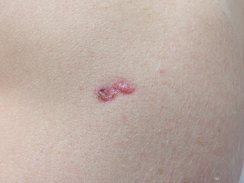 Superficial basal cell carcinoma, clinical photograph