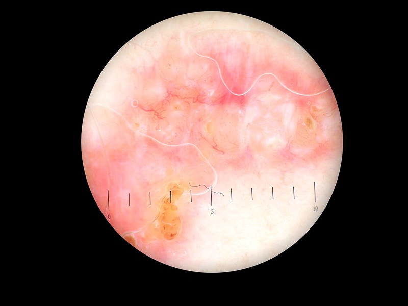 Dermoscopy image of a superficial basal cell carcinoma