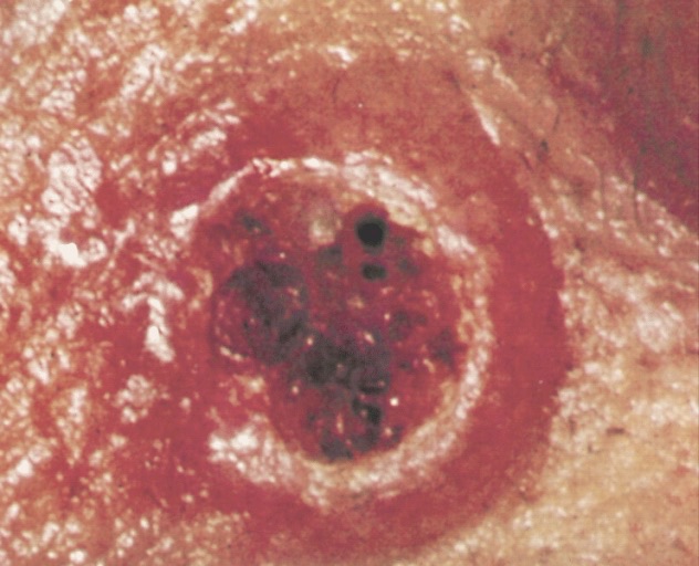 Keratoacanthoma, a squamous cell carcinoma variant, clinical photograph