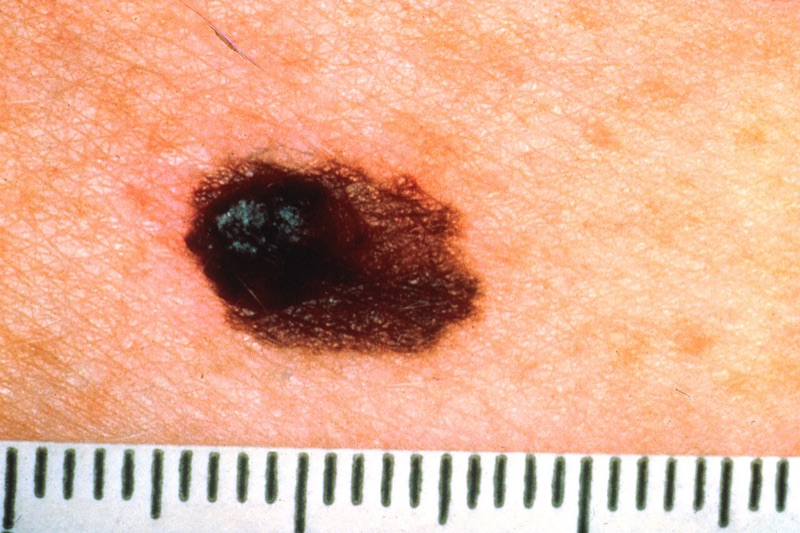 Melanoma showing asymmetry, with a ruler for scale