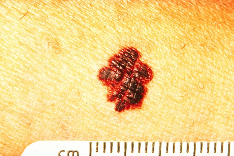 Melanoma with an uneven, ragged border, with a ruler for scale