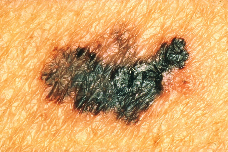 Melanoma with variation in colour