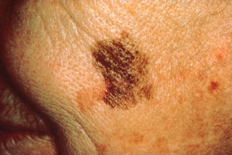 Melanoma with an increase in diameter