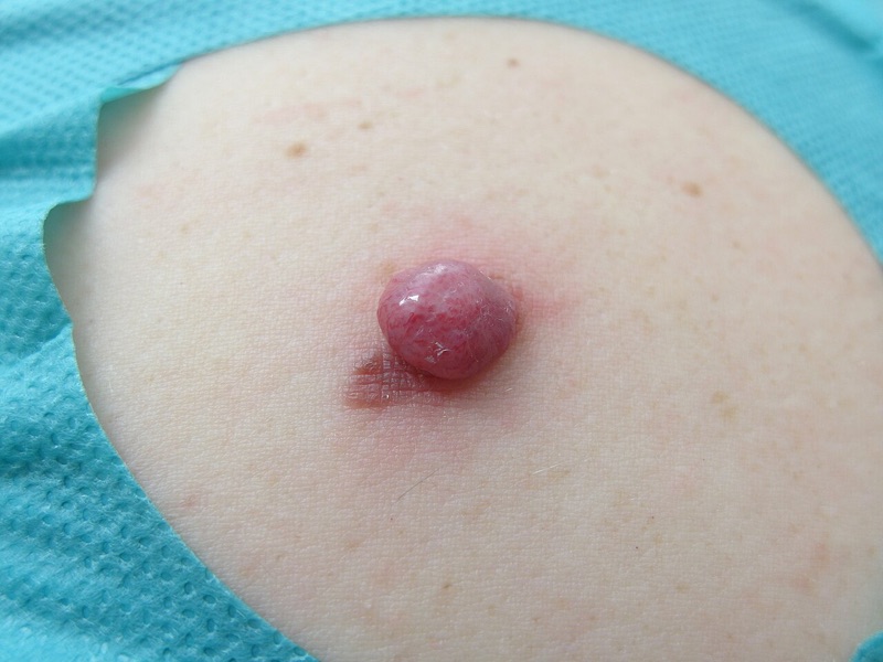 Amelanotic (non-pigmented) melanoma, clinical photograph