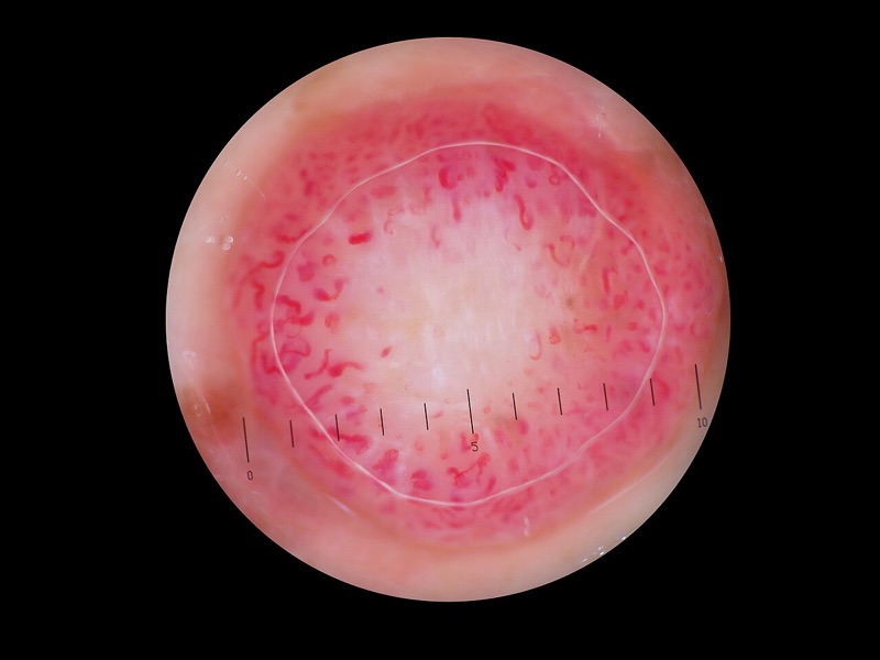 Dermoscopy image of an amelanotic melanoma