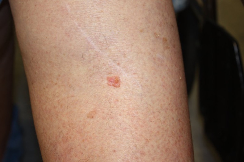 Small squamous cell carcinoma on the arm, clinical photograph