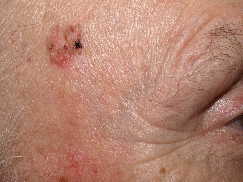 Squamous cell carcinoma in situ (Bowen's disease) on sun-damaged skin