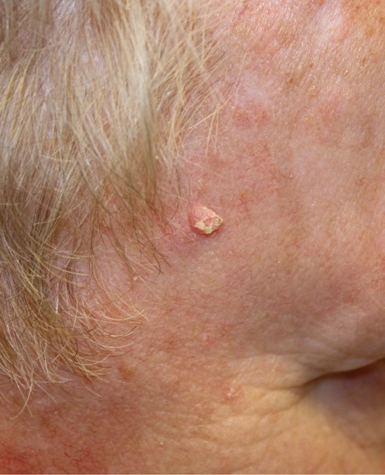 Small keratotic squamous cell carcinoma near the temple, clinical photograph